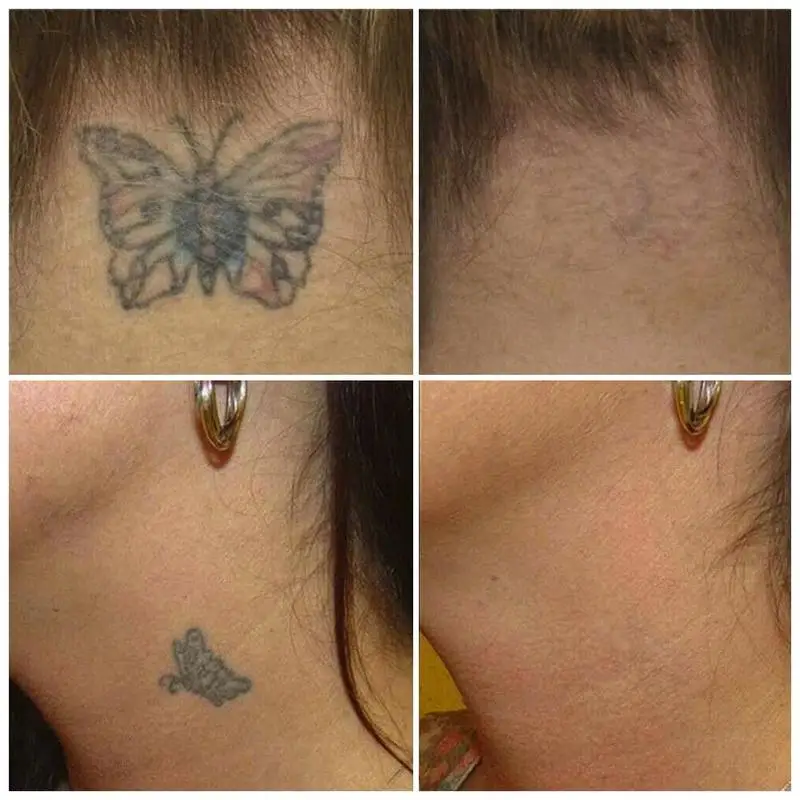 Kép /Állandó-tetoválás-eltávolítása-krém-természetes-6-9597-thumb.jpg